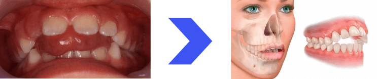 deglucion disfuncional